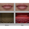 Lescolton Lip Care Device